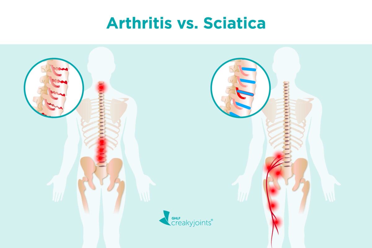 Anterior Pelvic Tilt and Sciatica