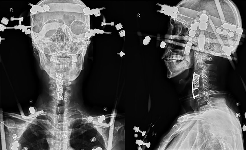 Halo Traction: Post-Procedure Care and Recovery