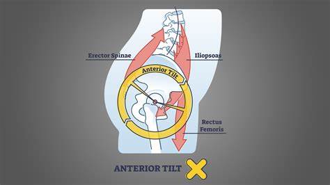 Anterior Pelvic Tilt Exercises PDF