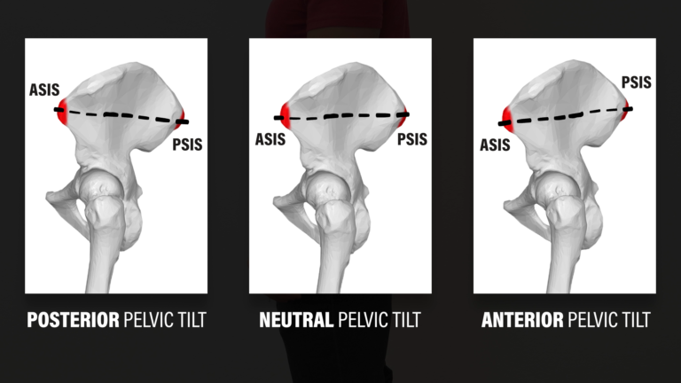 Understanding anterior pelvic tilt exercises pdf