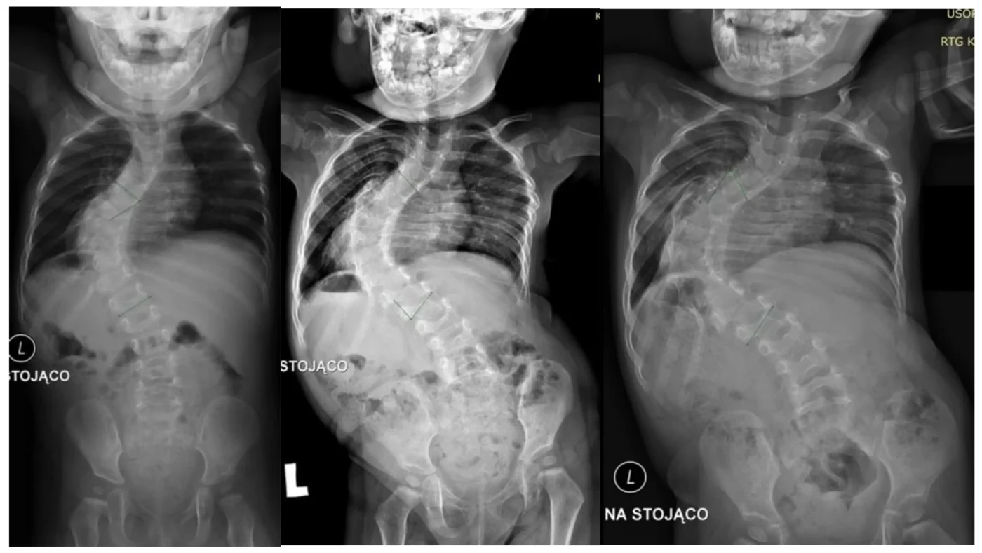 Severe Scoliosis X Ray