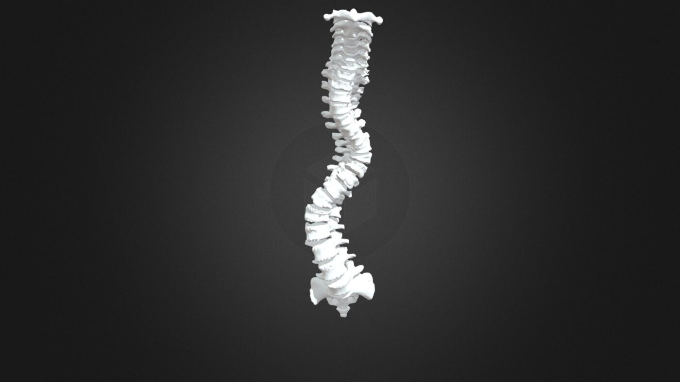 S Shaped Scoliosis of the Thoracolumbar Spine