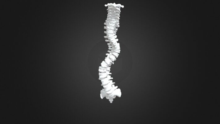 S Shaped Scoliosis of the Thoracolumbar Spine