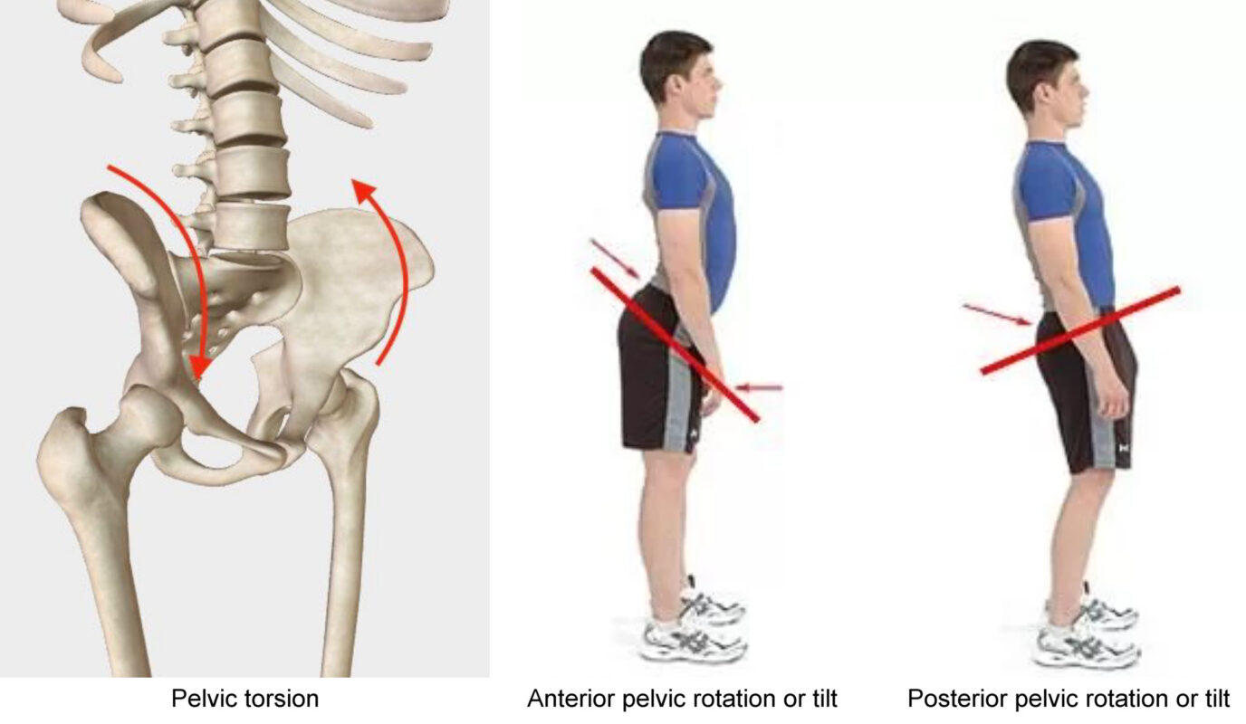 Surgery for anterior pelvic tilt
