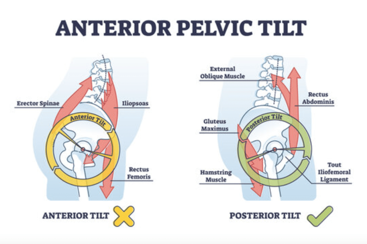 Can a Chiropractor Fix Anterior Pelvic Tilt